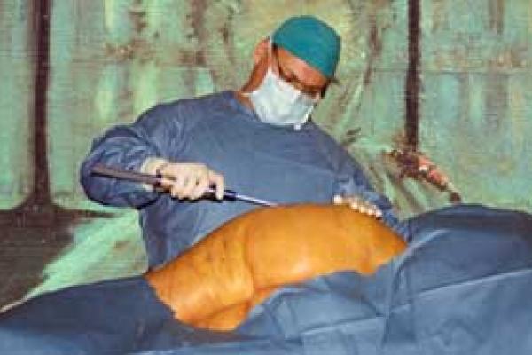 liposuction strzykawkowe